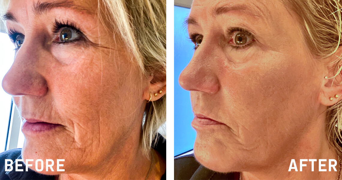 OSL_Before-after_Susanne_w-article_1140x600_ENG.jpg